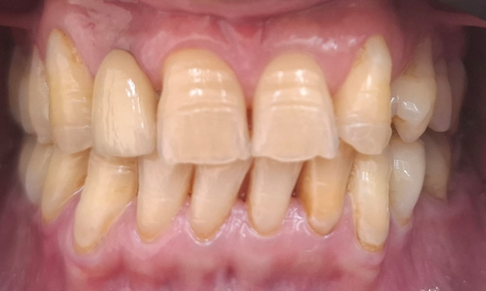 Dentes antes do clareamento dentário