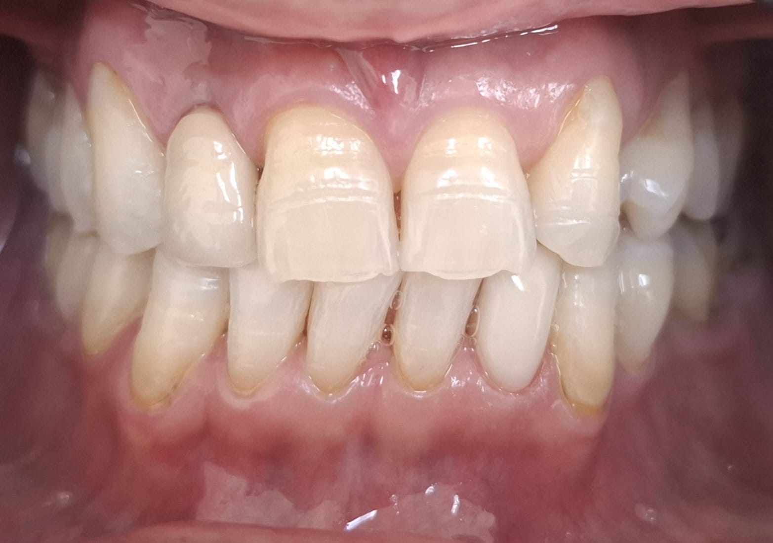 Dentes depois do clareamento dentário com a nova coroa sobre implante