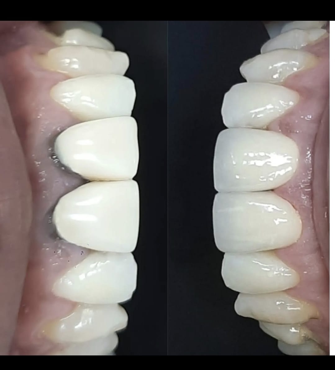 Antes e depois: substituição de coroas antigas e desadaptadas por cerâmicas livres de metal