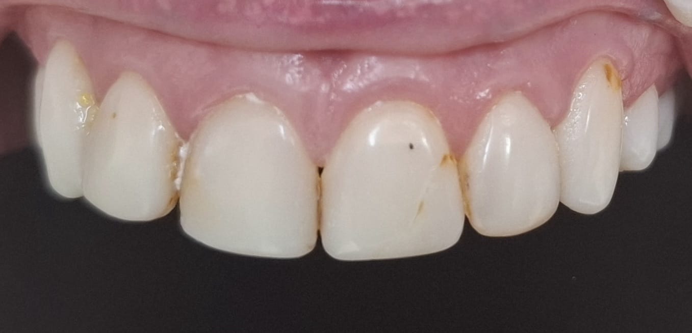 Sorriso antes da substituição das facetas antigas