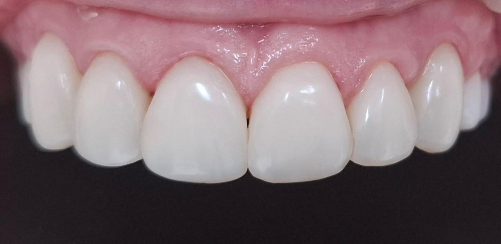 Sorriso depois da substituição das facetas