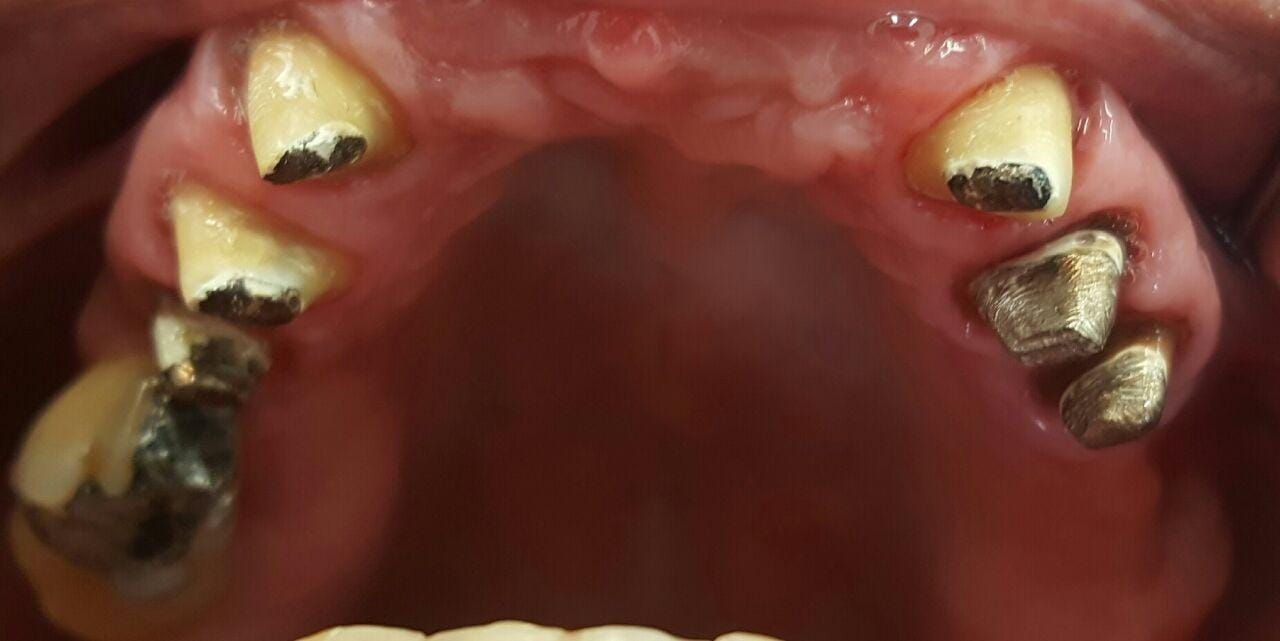 Dentes comprometidos antes da ponte fixa