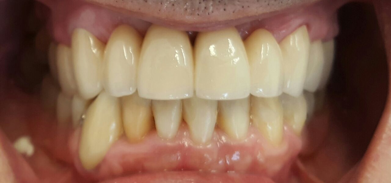 Sorriso reabilitado com a ponte fixa