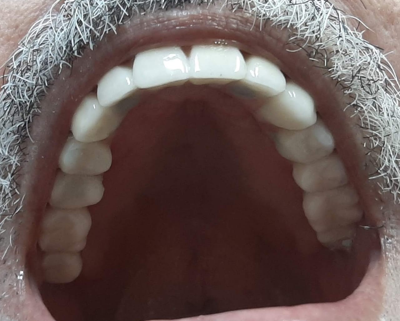 Prótese tipo protocolo instalada sobre implantes