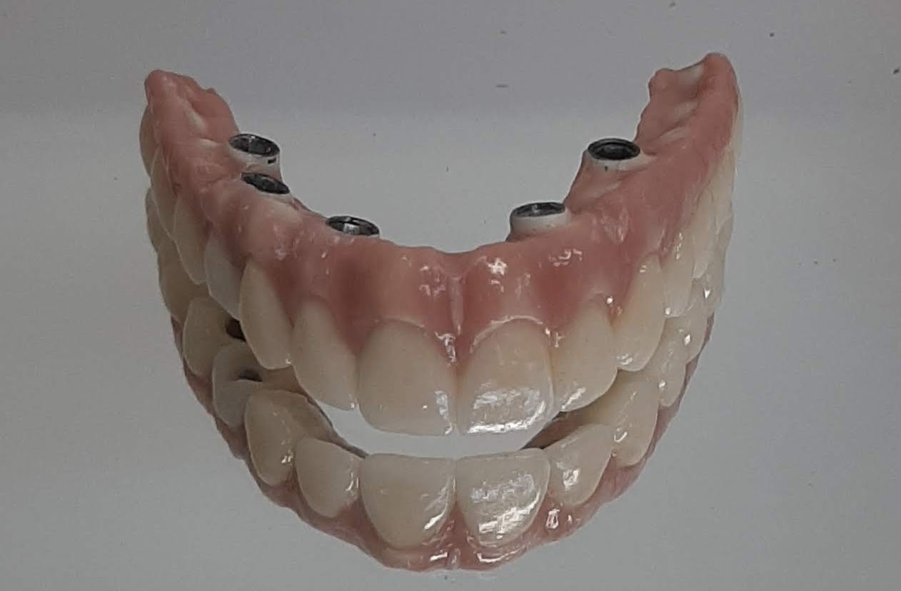 Prótese tipo protocolo — estrutura sobre implantes