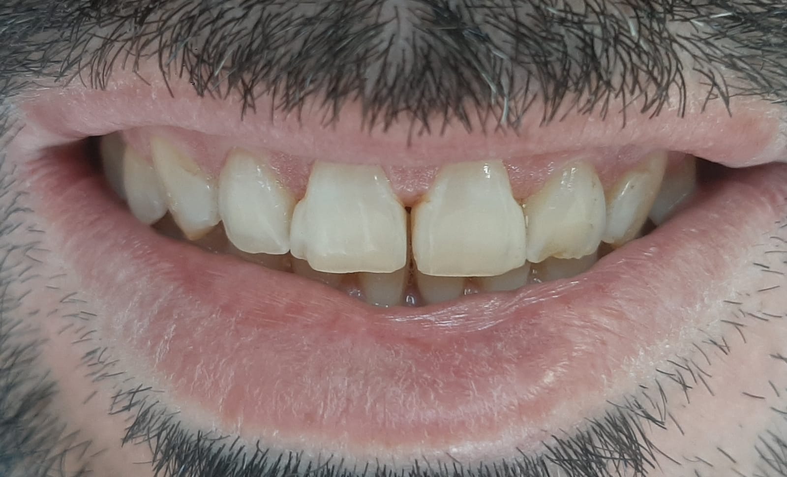 Sorriso antes da reabilitação oral em paciente com bruxismo