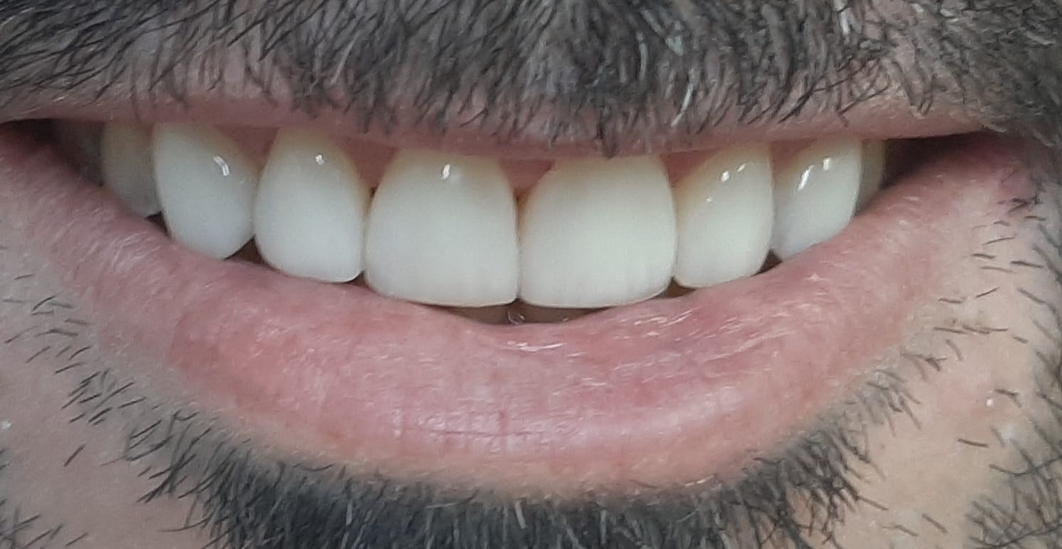 Sorriso depois da reabilitação oral
