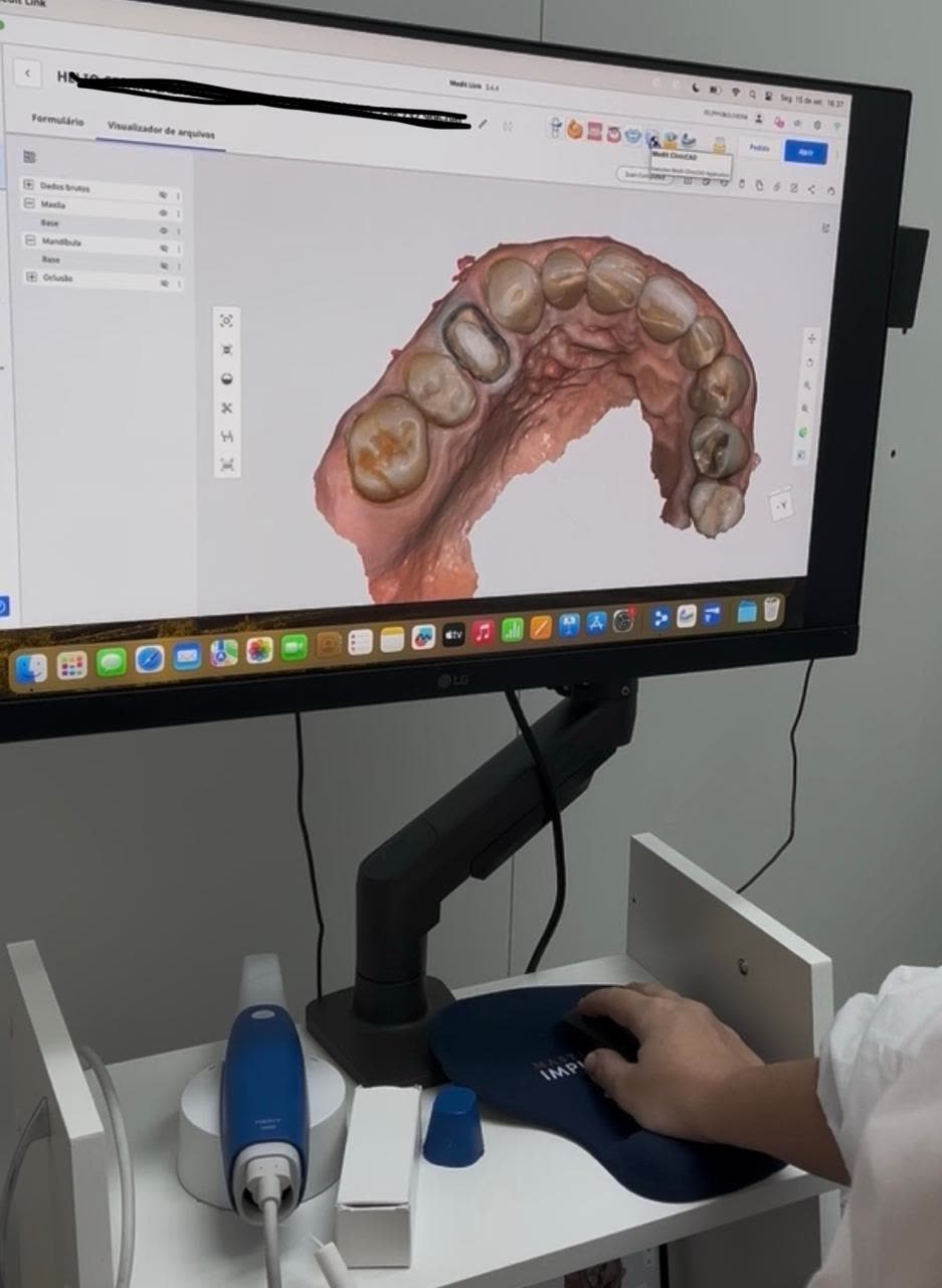 Scanner intraoral com o modelo 3D da arcada na tela